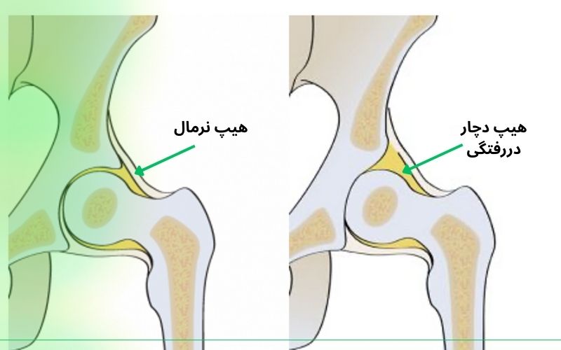 درمان خانگی دررفتگی لگن ممکن است؟