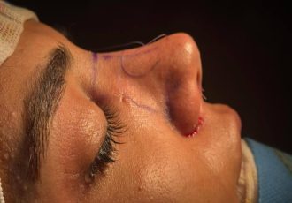 تغییر چهره بدون از دست دادن زیبایی طبیعی با عمل رینوپلاستی تغییر چهره بدون از دست دادن زیبایی طبیعی با عمل رینوپلاستی