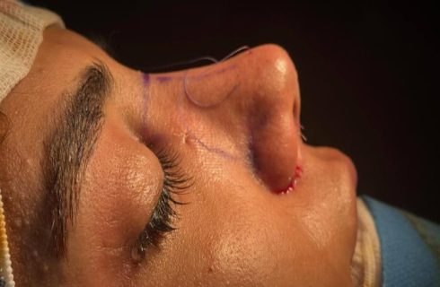 تغییر چهره بدون از دست دادن زیبایی طبیعی با عمل رینوپلاستی تغییر چهره بدون از دست دادن زیبایی طبیعی با عمل رینوپلاستی